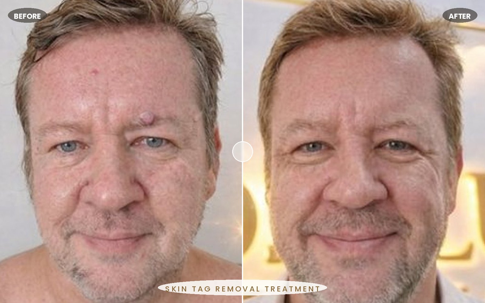 Roseluxe treatment 1