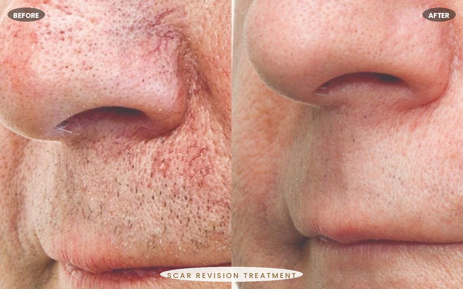 Roseluxe treatment 6