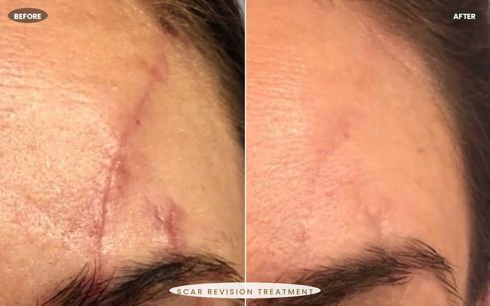 Roseluxe treatment 10