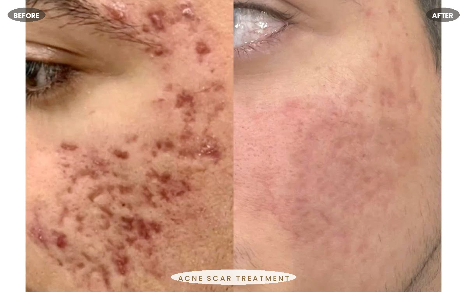 Roseluxe treatment 3