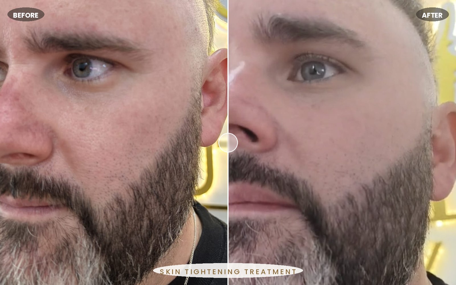 Roseluxe treatment 4