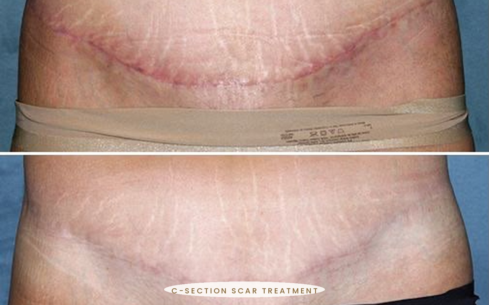 Roseluxe treatment 13
