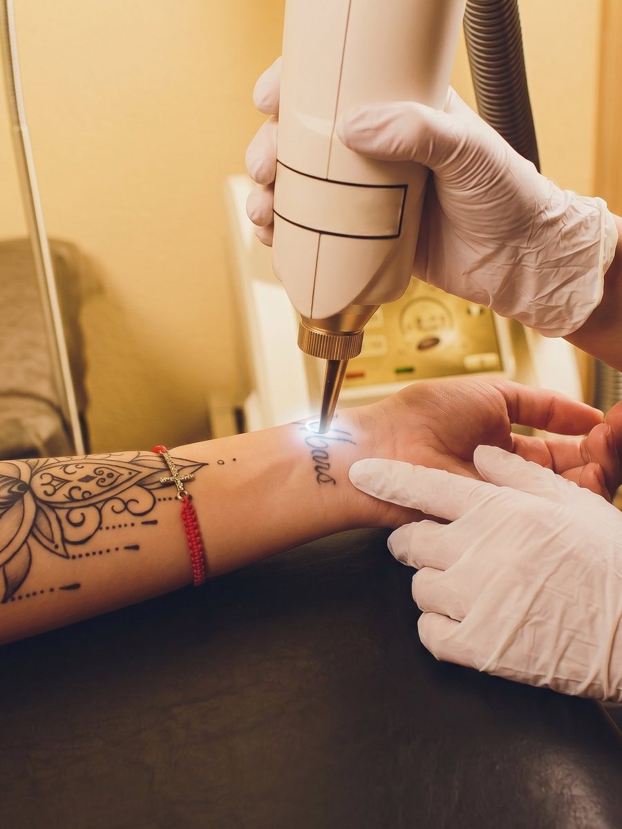 Laser Tattoo Removal
