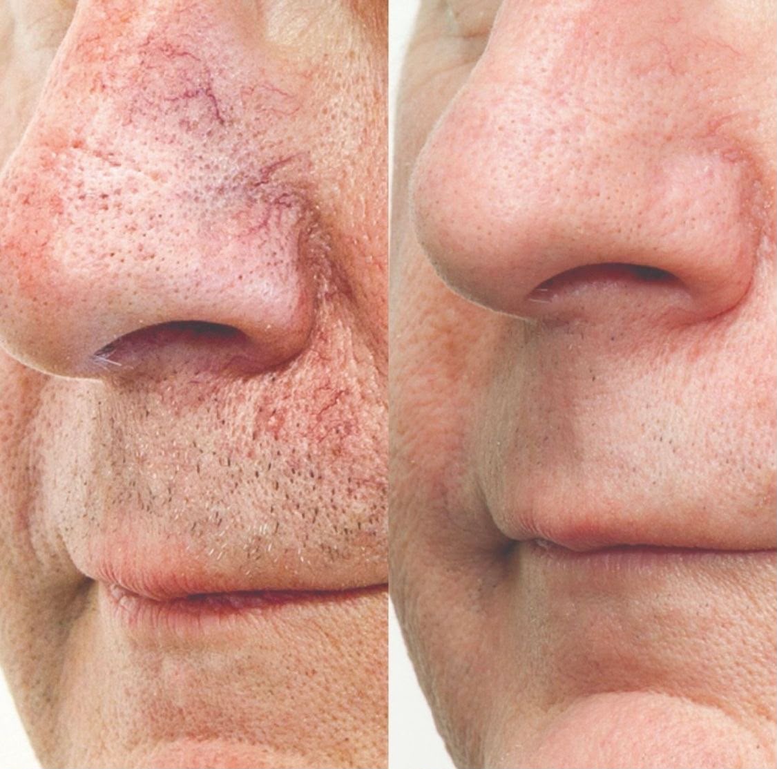 Scar Revision Treatment