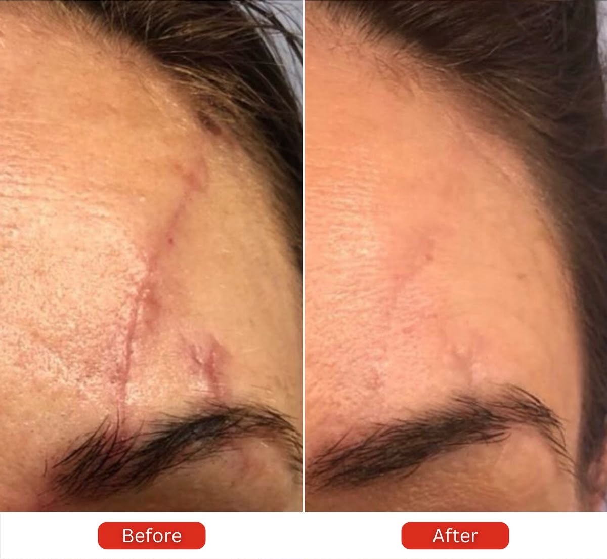 Scar Revision Treatment