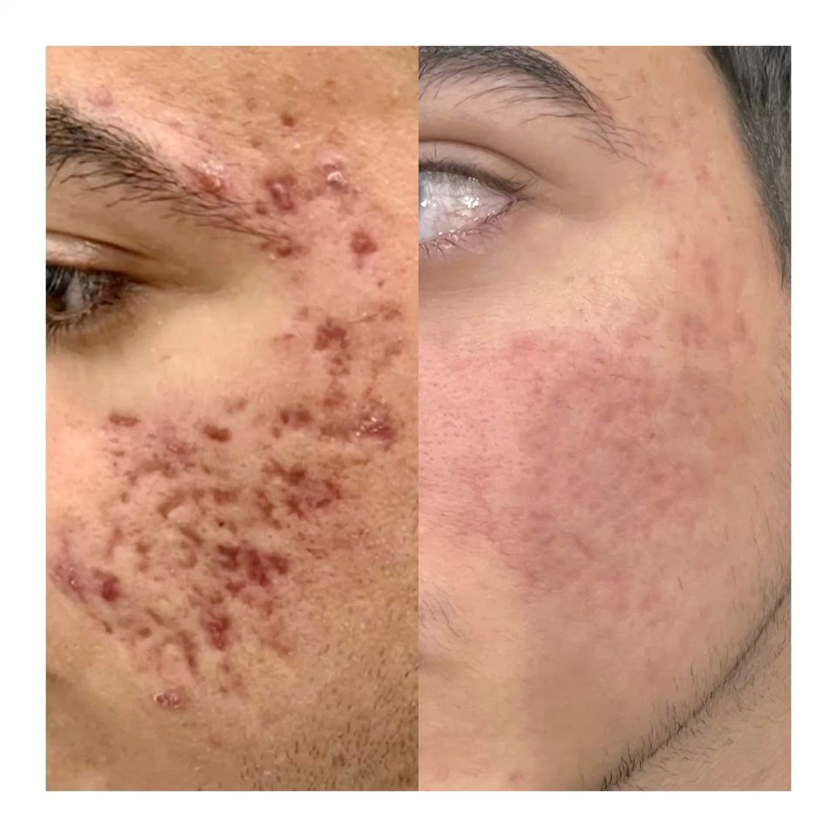 Acne Scar Treatment