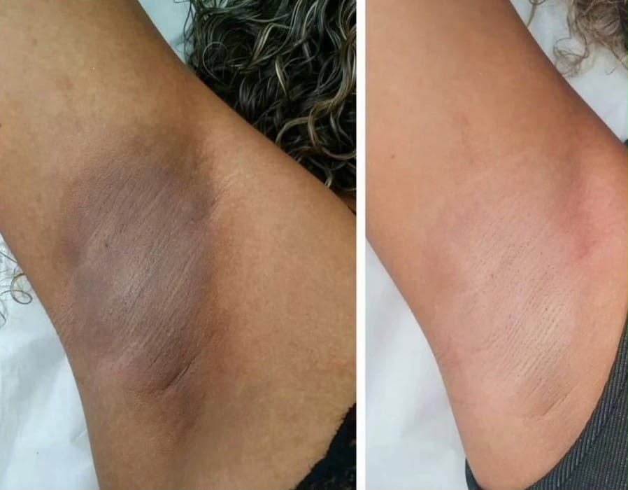 Underarm Brightening Treatment