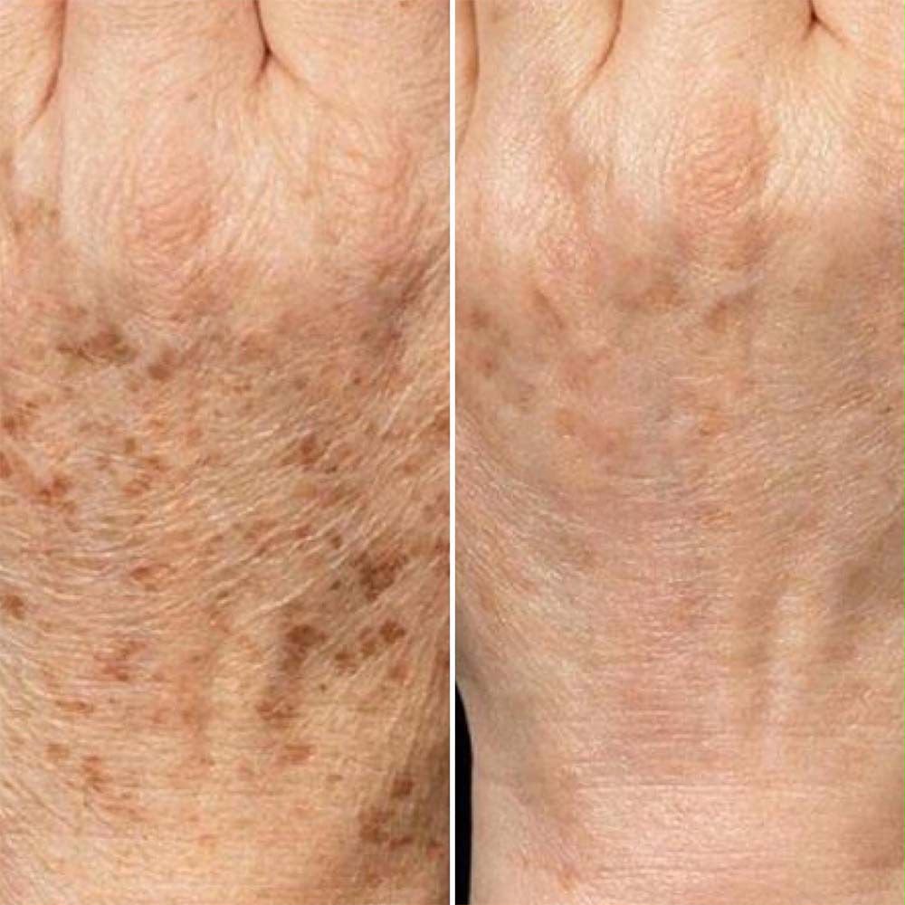 Dark Spots Treatment 