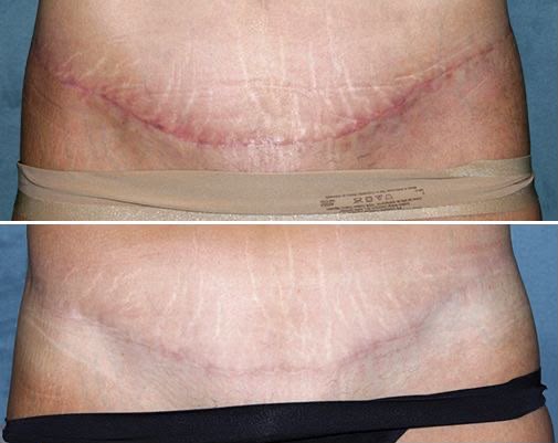 C-Section Scar Treatment 